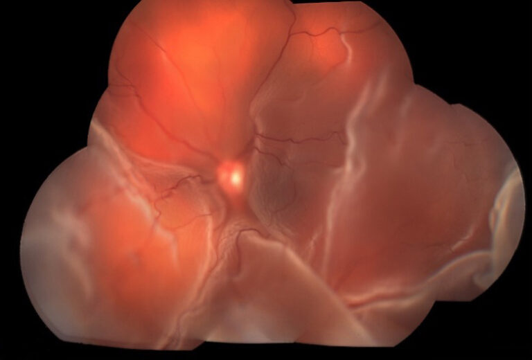 Retinal Detachment Columbia Retina Missouri Missouri Retina